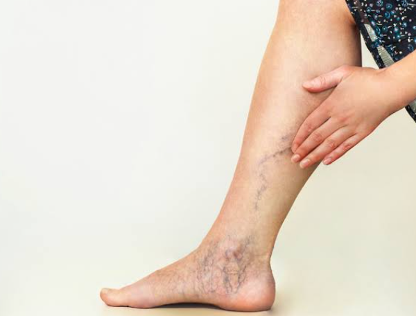 Vein Treatment: What to Expect and When to Consider It