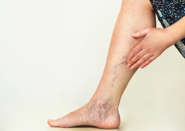 Vein Treatment: What to Expect and When to Consider It